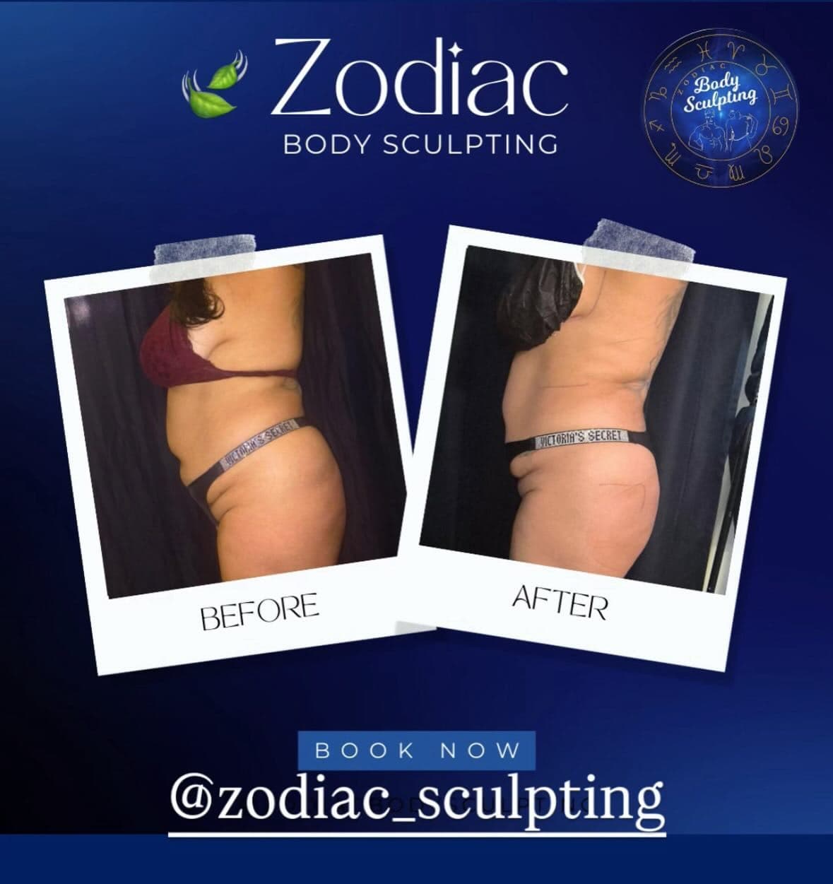Zodiac Body Sculpting before and after results — real client transformation